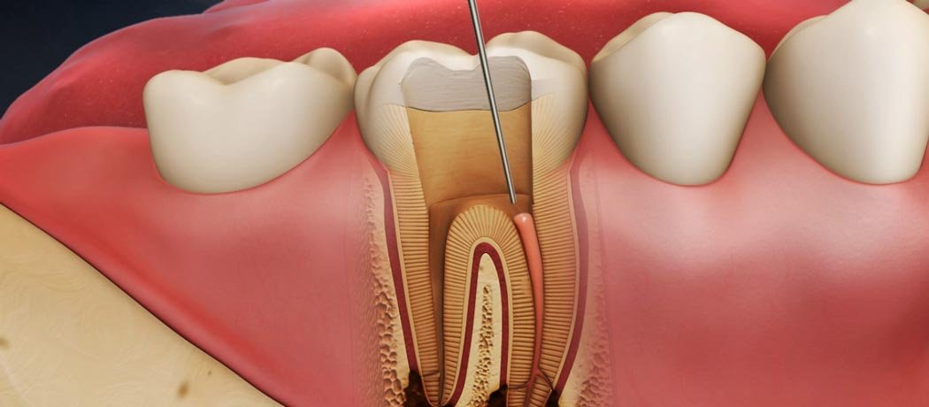 Endodontic Dentistry, Shankar Dental Clinic, Ramnagar, Nainital