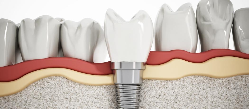 Tooth Implants, Shankar Dental Clinic, Ramnagar, Nainital