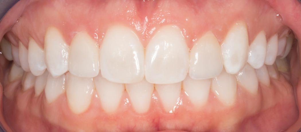 Teeth Whitening, Shankar Dental Clinic, Ramnagar, Nainital