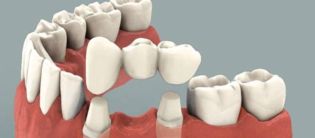Crowns and Bridges, Shankar Dental Clinic, Ramnagar, Nainital