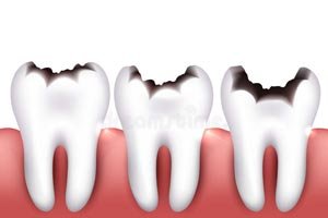 Dental Caries