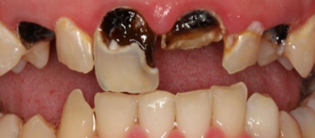 Dental caries, Shankar Dental Clinic, Ramnagar, Nainital