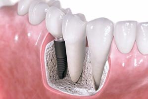 Dental Implants