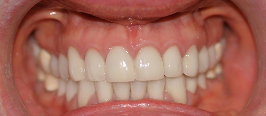 Full Mouth Rehabilitation, Shankar Dental Clinic, Ramnagar