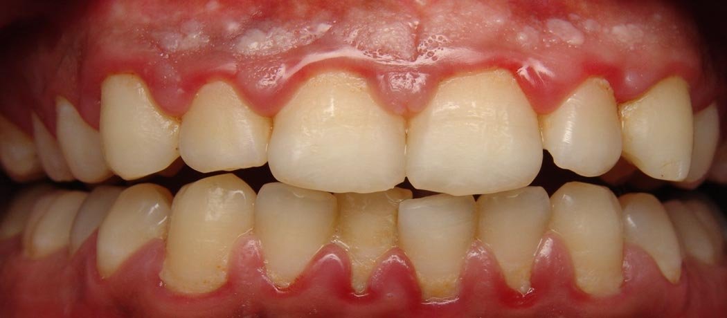 Gum Disease, Shankar Dental Clinic, Ramnagar, Nainital
