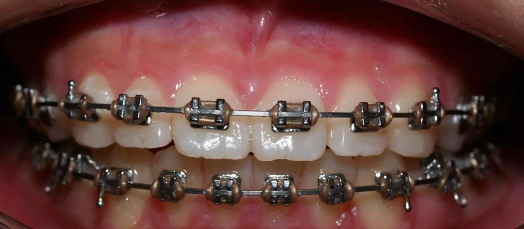Orthodontics, Shankar Dental Clinic, Ramnagar, Nainital