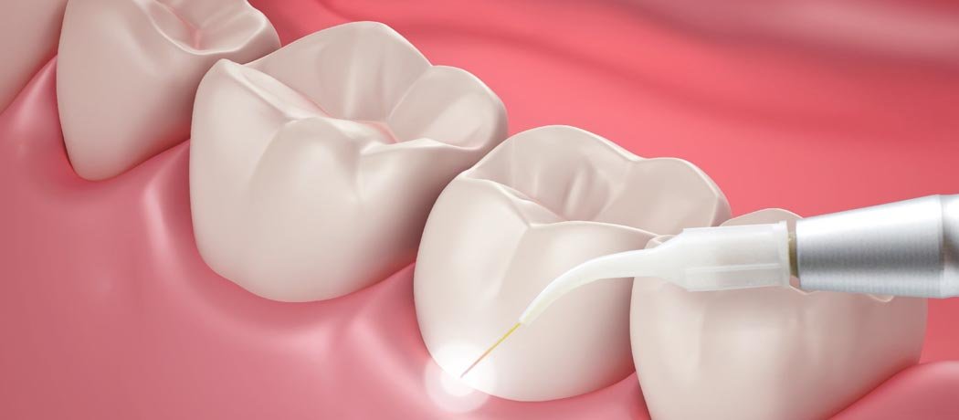 Periodontology, Shankar Dental Clinic, Ramnagar, Nainital