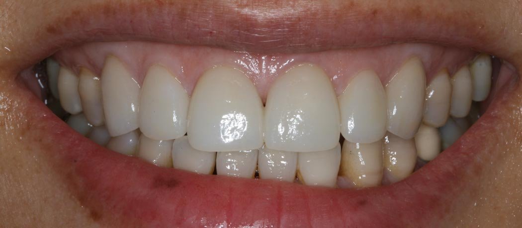 Porcelain Veneers