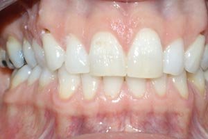  Porcelain veneers