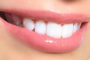 Smile Makeover