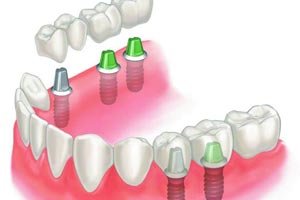 Teeth Implants