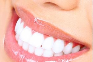 Teeth whitening