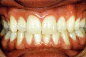 White Fillings