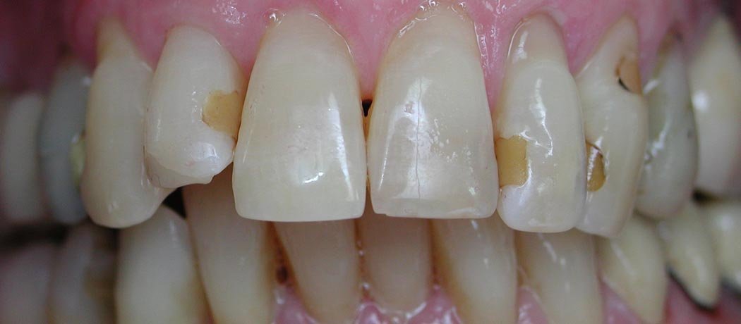 White fillings, Shankar Dental Clinic, Ramnagar, Nainital